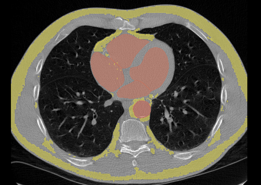 Chest CT showing segmented anatomy and peri-aortic fat